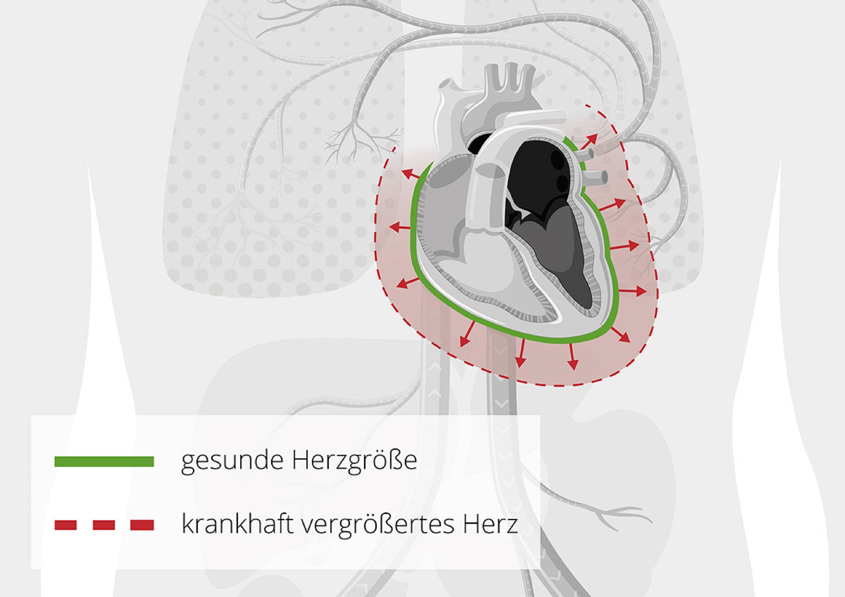 Globale Herzinsuffizienz grafisch dargestellt.
