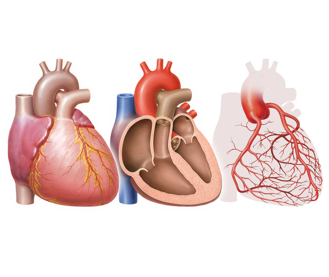 Darstellung der Herzkranzgefäße: verengte Koronararterien als Ursache der koronaren Herzkrankheit (KHK) 