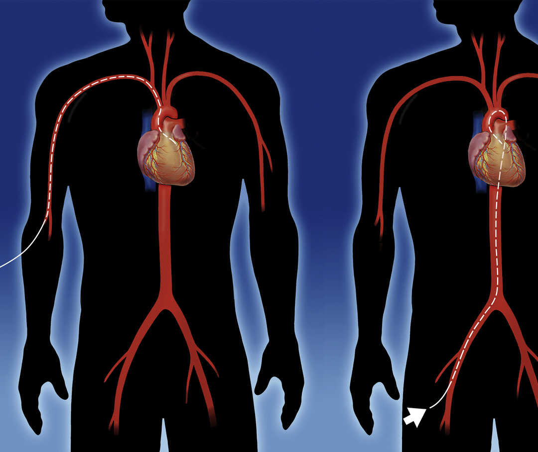 Schematische Darstellung von Herz und Blutgefäßen, die die möglichen Zugänge eines Herzkatheters zeigt.