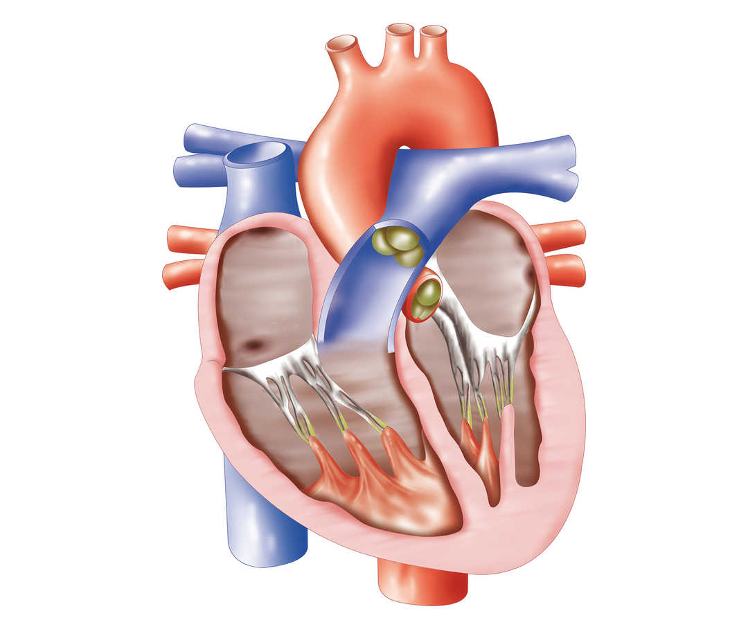 Herz im Querschnitt – eine Mitralklappeninsuffizienz betrifft die Klappe zwischen linkem Vorhof und der Herzkammer.