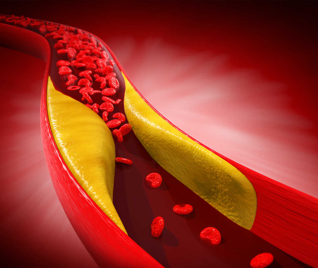 Arteriosklerose grafisch dargestellt: Ablagerungen in den Blutgefäßen führen zur Arterienverkalkung.