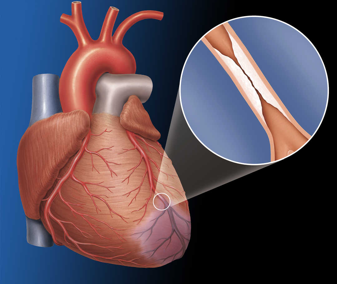 Сердечно сосудистые заболевания атеросклероз. Атеросклероз сосудов сердца. Атеросклероз коронарных артерий. Атеросклероз коронарных сосудов. Закупорка артерии в сердце.