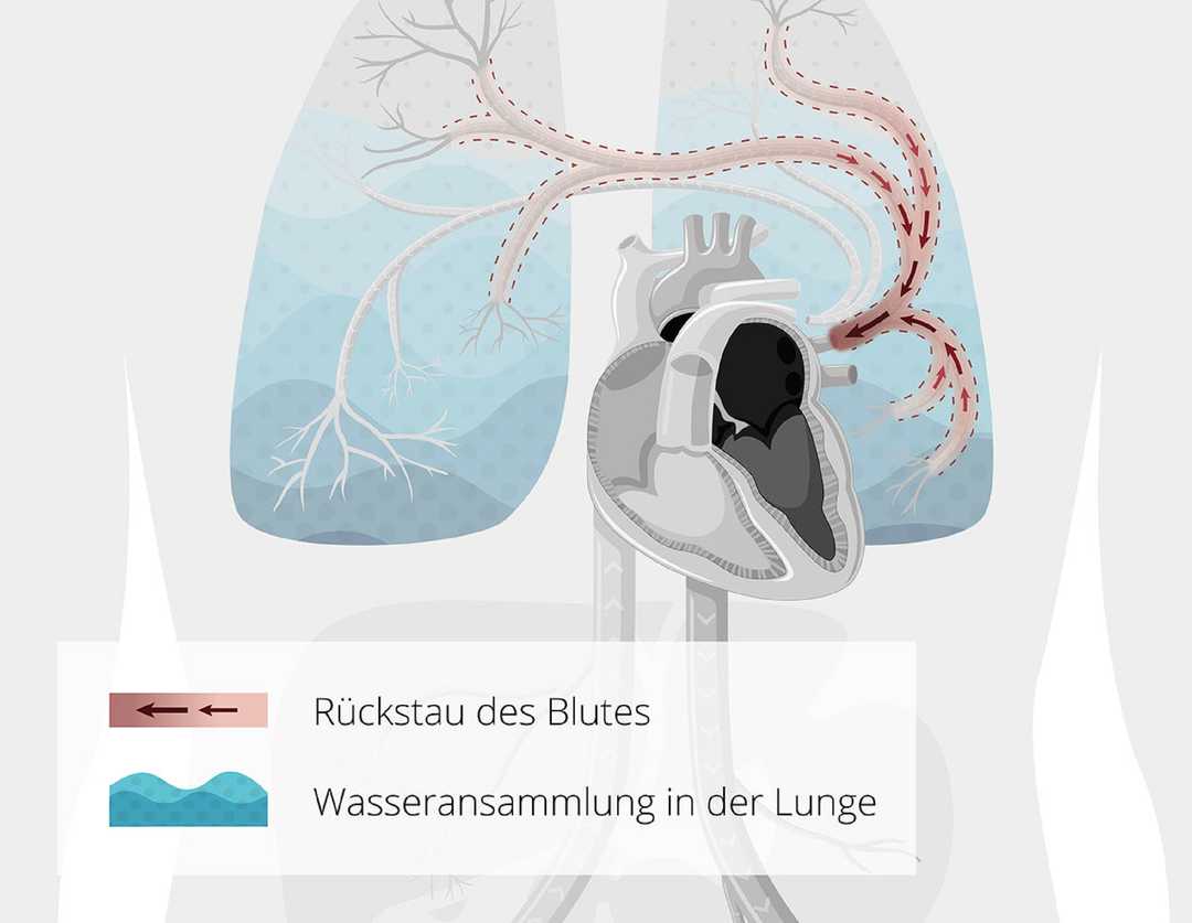 Linksherzinsuffizienz: Rückstau von Blut in der Lunge Grafik der Linksherzinsuffizienz, die zu Asthma cardiale führen kann.
