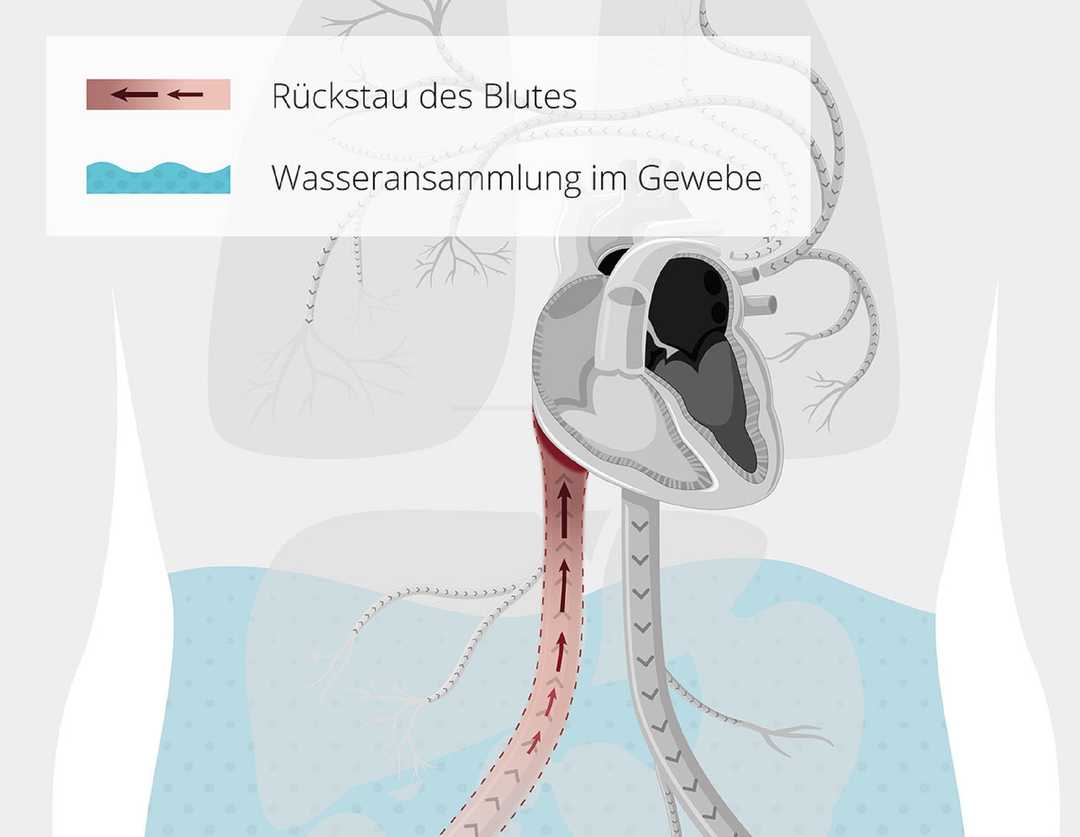 Rechtsherzinsuffizienz Was Ist Das Ratgeber Herzinsuffizienz