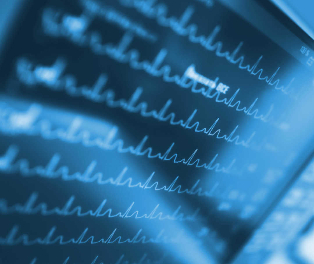 Tachykardie: Ein Elektrokardiogramm zeigt Herzrasen an.