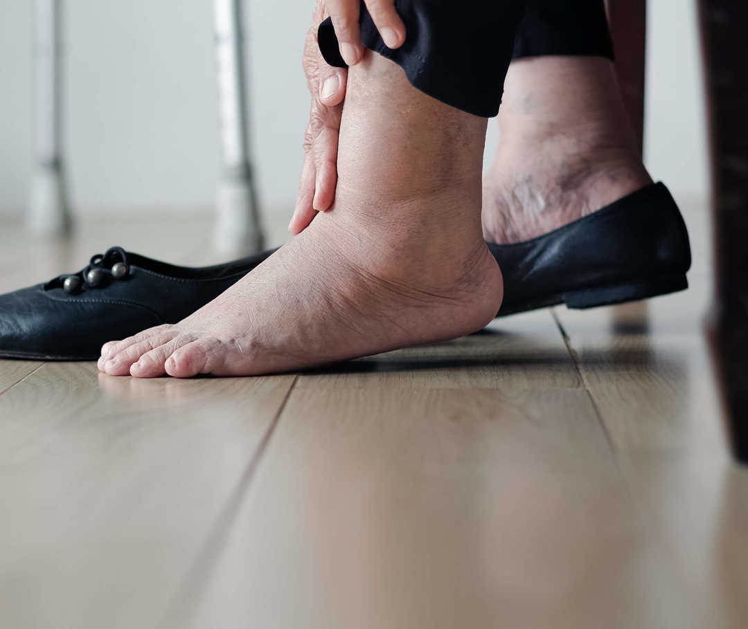 Eine Person hat einen ihrer geschwollenen Füße in einem Schuhe, den anderen berührt sie mit ihren Händen.