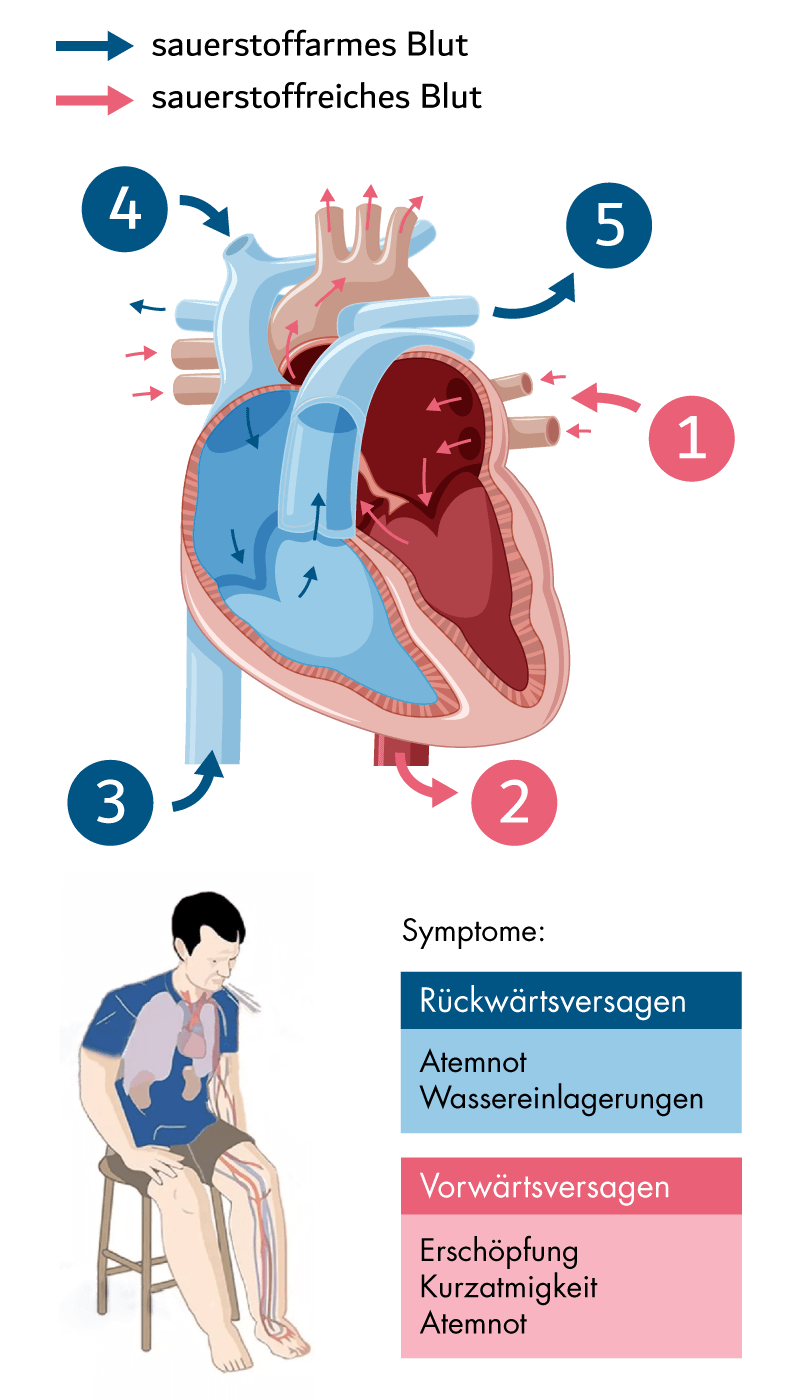 Bei einer globalen Herzinsuffizienz kommt es zum Vorwärts- und Rückwärtsversagen des Herzens.