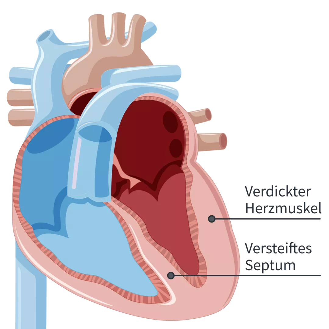 Kompensierte Herzinsuffizienz – Darstellung vergrößerte linke Herzkammer