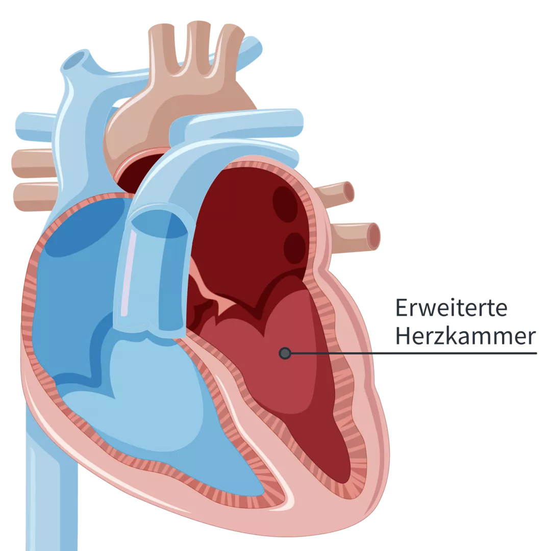 Darstellung Vergrößerung der linken Herzkammer