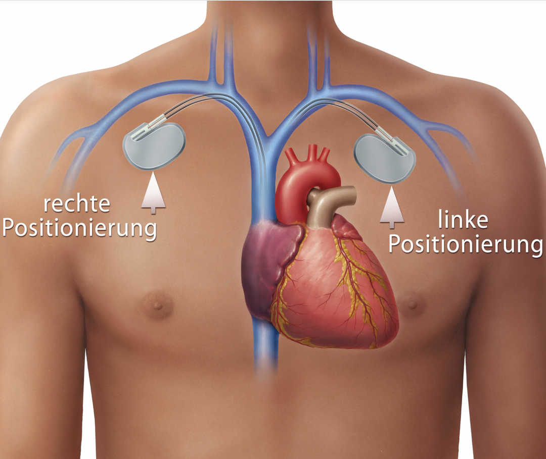 Grafik zeigt mögliche Positionierung eines Herzschrittmachers auf der linken oder rechten Seite unterhalb des Schlüsselbeins.