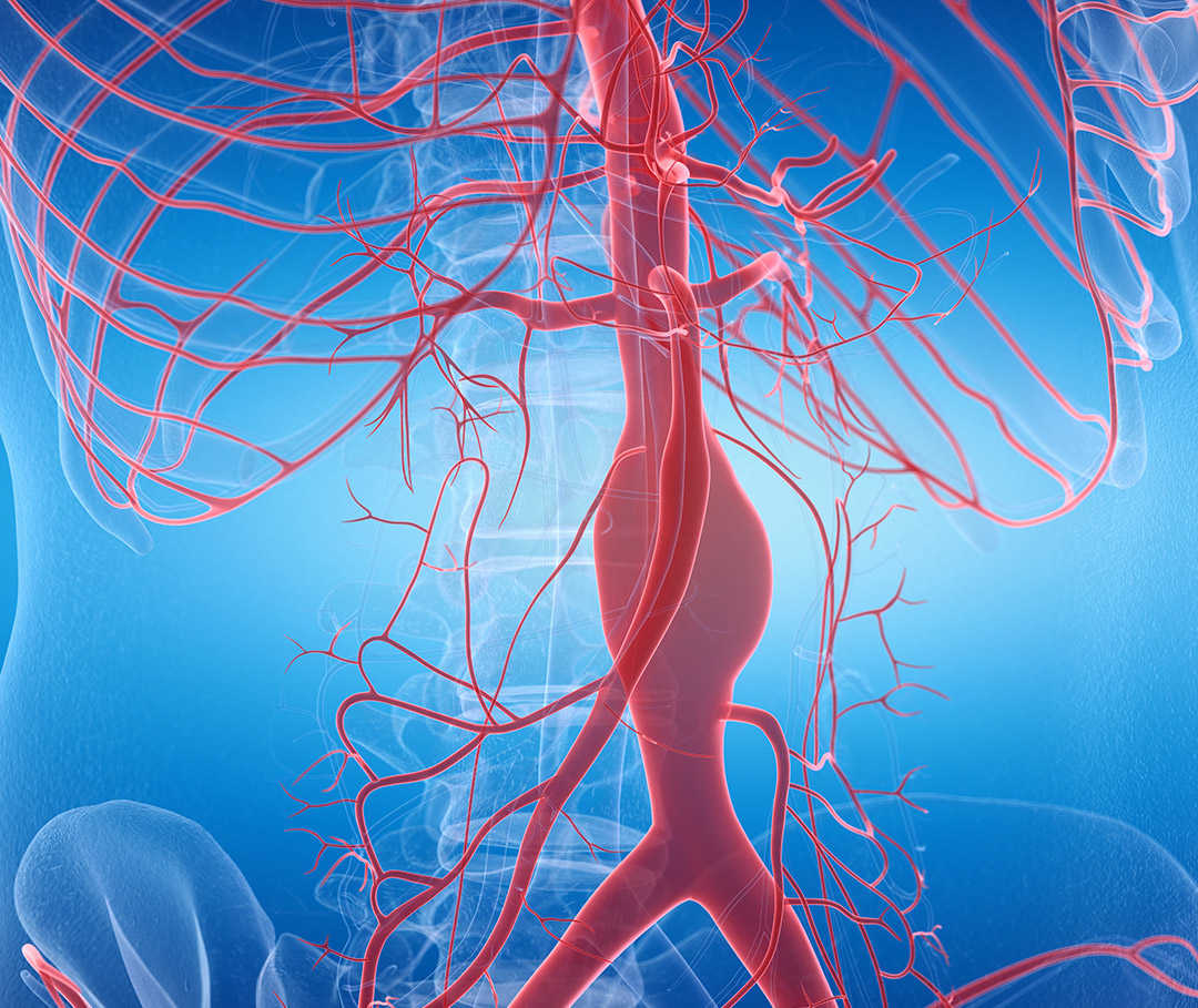 Bei einem Aortenaneurysma ist die Hauptschlagader erweitert. 3D-Illustration eines Aortenaneurysmas