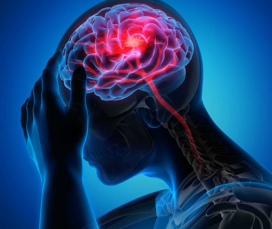 Digitale Darstellung einer Person, die sich an den Kopf fasst – im Gehirn ist ein Blutgerinnsel als Ursache für einen Schlaganfall zu erkennen.