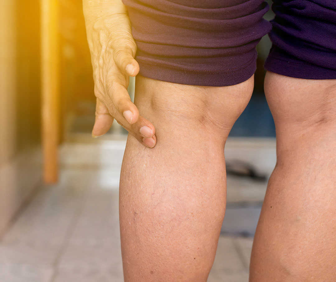 Person fasst sich an die linke Wade, die aufgrund einer Beinvenen-Thrombose schmerzt.