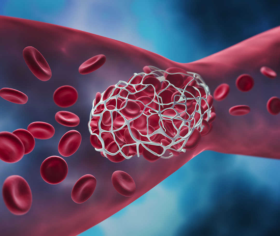 Bei einer Thrombose ist ein Blutgefäß verstopft. Digitale Darstellung eines Blutgerinnsels in der Blutbahn
