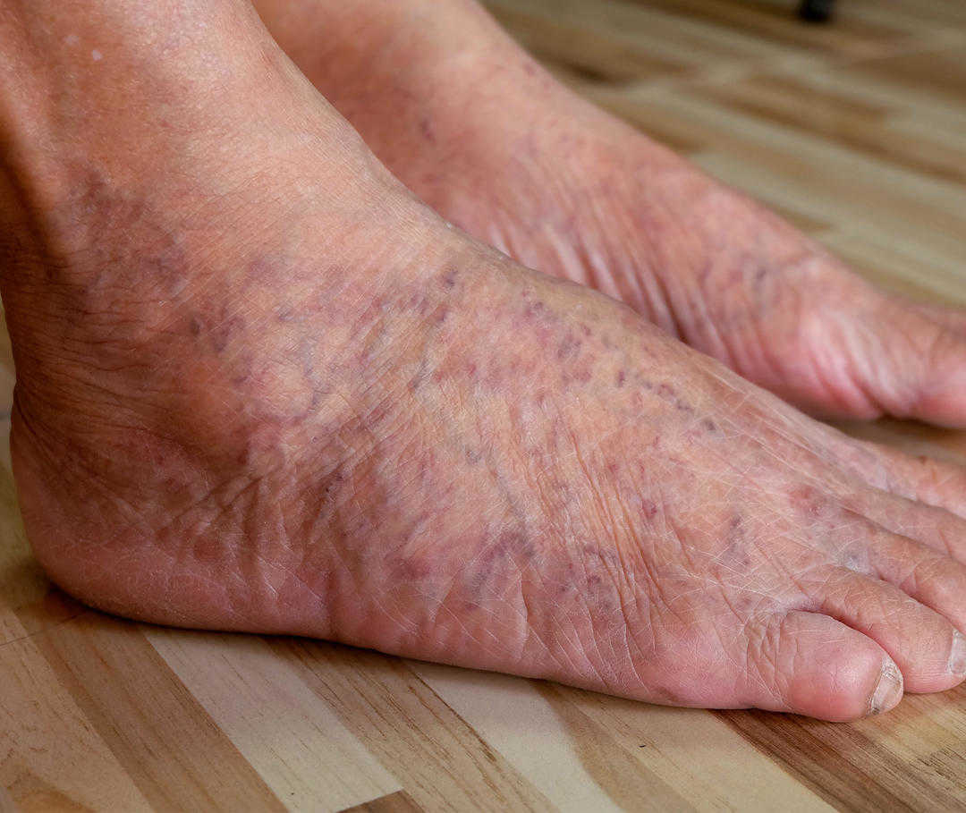 Geschwollene Knöchel – ein häufiges Symptom bei Rechtsherzinsuffizienz